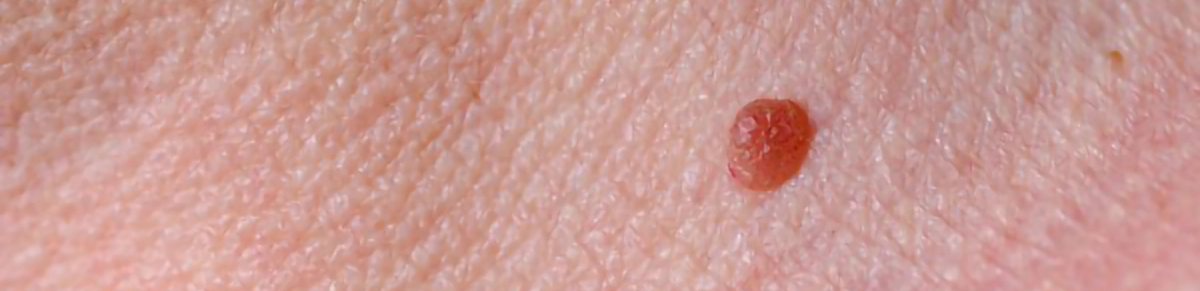 skin-lesion